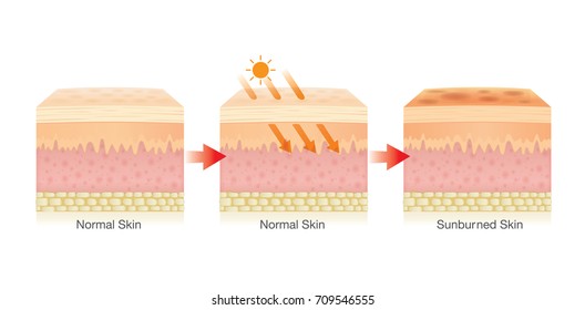 Step of Changing of human skin layer damaged from sunlight. Illustration about Health care.