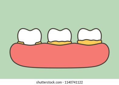 step of plaque or tartar, cause of tooth periodontal disease - dental cartoon vector flat style cute character for design
