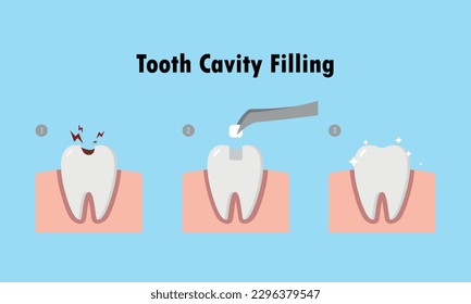 Step of restoring cavity tooth by filling tooth illustration cartoon character vector design on blue background. Dental care concept.