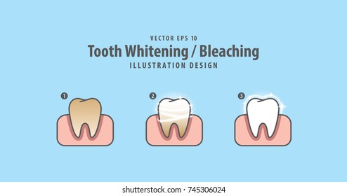 Step of single tooth Whitening-Bleaching and human gum illustration vector on blue background. Dental concept.