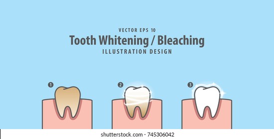 Step of single tooth Whitening-Bleaching and human gum illustration vector on blue background. Dental concept.