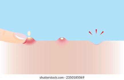 Step of squeeze acne to rolling scar vector illustration on sky blue background. The inflammatory acne, pustule on skin, squeeze pimple with finger to acne scar. Before and after skin care concept.