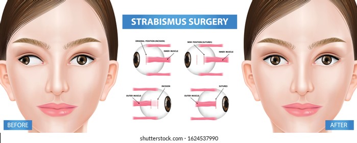 Step of strabismus surgery, crossed eye before and after vector illustration