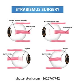 Step strabismus surgery , crossed eye vector illustration