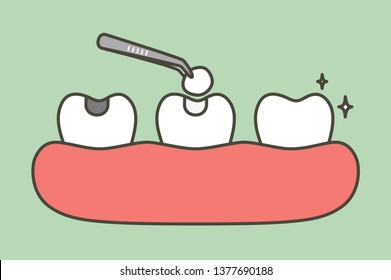 step of tooth amalgam filling by dental tools to protection decay tooth, before and after - teeth cartoon vector flat style cute character for design