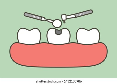 step of tooth amalgam filling by dental tools to protection decay tooth - teeth cartoon vector flat style cute character for design