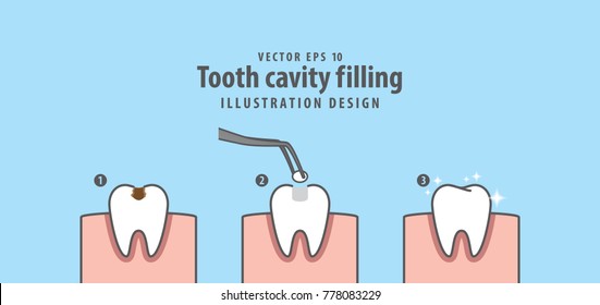 Step of tooth cavity filling illustration vector on blue background. Dental concept.