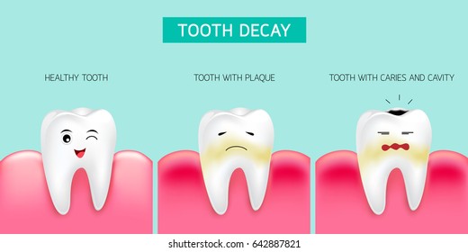 Step Of Tooth Decay Formation. Healthy Tooth, Forming Dental Plaque And Finally Caries And Cavity. Cute Cartoon Design, Illustration Isolated On Green Background. Dental Care Concept.