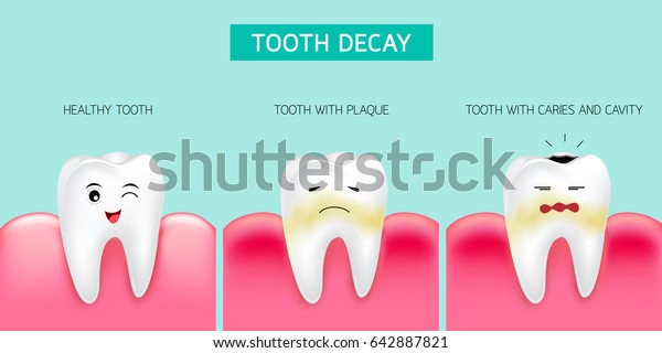 Schritt Der Zahnzerfallsbildung Gesunder Zahn Bildung Stock Vektorgrafik Lizenzfrei