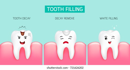 Step Tooth Filling Tooth Decay Decay Stock Vector (Royalty Free ...