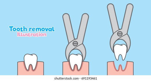 Step of Tooth removal illustration vector on blue background. Dental concept.