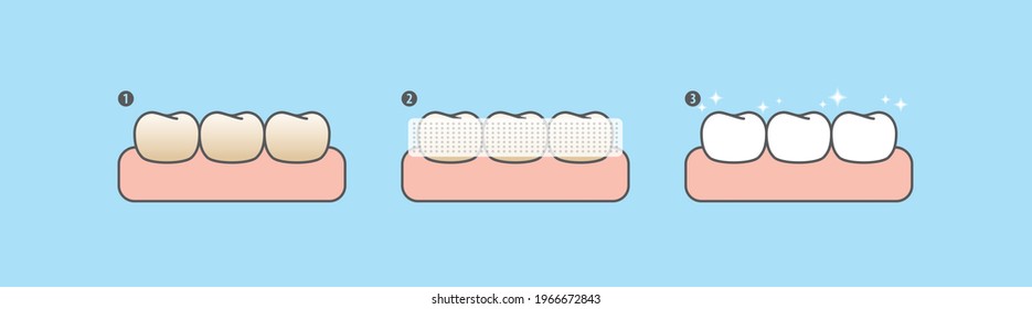 Step Of Whitening Teeth By Teeth Whitening Strips. Illustration Vector Design On Blue Background. Dental Care Concept.