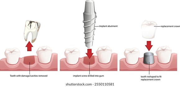 Guía paso a paso para el proceso de implantes dentales