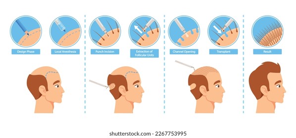 A Step-by-step Infographic To Hair Transplantation Procedure. Design Phase, Local Anesthesia, Punch Incision, Extraction of Follicular Units, Channel Opening and Result. Cartoon Vector Illustration