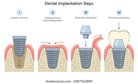 Zahnimplantationsschritte, Implantateinbau, Heilungsprozess, Abutmentplatzierung, Prothesenplatzierungsdiagramm, handgezeichnete schematische Vektorillustration. Medizin-Bildungs-Illustration