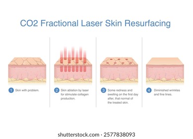 Steps of problem skin treatment with CO2 fractional laser to skin resurfacing. Skin ablation by laser energy for stimulate new collagen and elastin production.