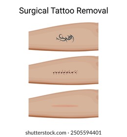 Steps of Surgical Tattoo Removal Process. Vector illustration design.