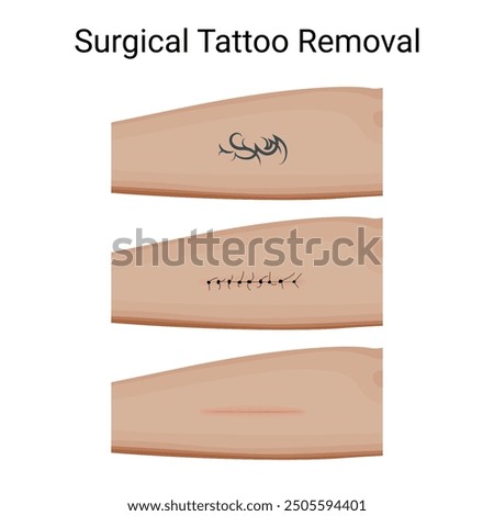 Steps of Surgical Tattoo Removal Process. Vector illustration design.