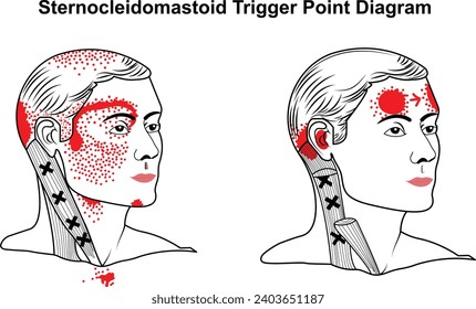 Sternocleidomastoid Trigger Point vector Diagram