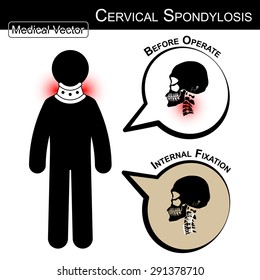 Stick man with hard collar (Cervical spondylosis) and bubble (Before operate, After operate internal fixation by plate and screw at cervical spine) (Medical, Health, Healthcare vector) infographic svg