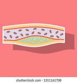 Sticker vienna human atherosclerosis.the structure of a veins . the veins in the manifestation of the disease