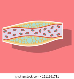 Sticker vienna human atherosclerosis.the structure of a veins . the veins in the manifestation of the disease