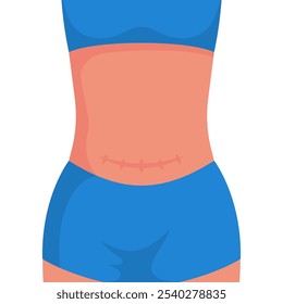 Costura após cesariana na barriga feminina. Suturas após cesariana. Operação cirúrgica de parto. Design plano de ilustração vetorial. Isolado no fundo branco.