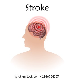 Stoke poster, banner. Vector medical illustration. White background, pink silhouette of man head, anatomy image of damaged human brain.