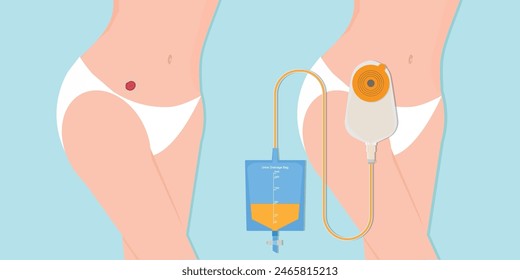 Stoma and colostomy isolated on background. Urostomy bag containing urine flow through small bowel stoma to Urine Drainage Bag. Ostomy medical care equipment, vector illustration.