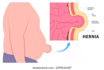 stomach abdominal pain small large intestine constipation belly button umbilical hernia or inguinal incisional Femoral diastasis recti ileus lump navel wall cavity baby infant birth volvulus Hiatus