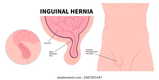 Anatomie der Leistenhernie, aus der ein Teil des Darms in medizinischen