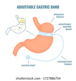 Stomach with adjustable gastric band device. 