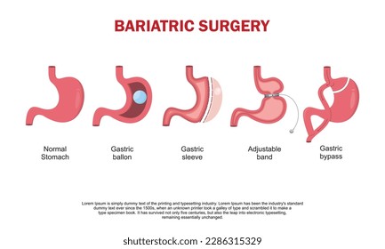 Stomach with adjustable gastric band device. Bariatric surgery weight loss procedure. Stomach reduction anatomical diagram infographic. Health care medical concept. Vector illustration