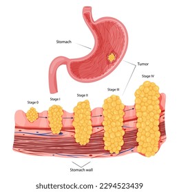 Stomach cancer, gastric tumor caused by disease, brings pain and discomfort. Medical vector illustration.