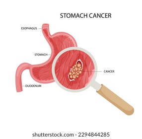 Stomach cancer. Malignant cancerous tumor enlarged under magnifying glass. Anatomical vector illustration isolated white background cartoon style