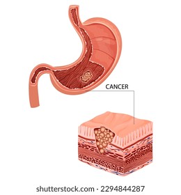 Stomach cancer. Malignant cancerous tumor. Anatomical vector illustration isolated white background cartoon style