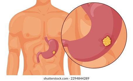 Stomach cancer. Malignant cancerous tumor. Anatomical vector illustration isolated white background cartoon style