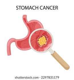 Stomach cancer. Malignant cancerous tumor enlarged under magnifying glass. Anatomical vector illustration isolated white background cartoon style