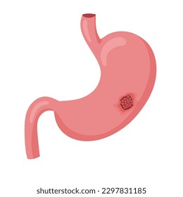 Magenkrebs. Maligner Tumor des Krebses. Anatomische Vektorgrafik einzeln auf weißem Hintergrund, Cartographie-Stil