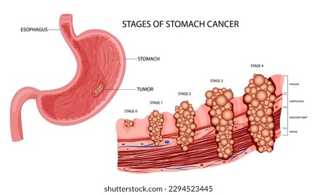 Stomach cancer. Stages growth malignant cancerous tumor. Anatomical vector illustration isolated white background cartoon style