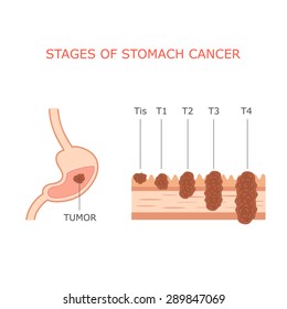 Stomach Cancer Stages, Human Gastric Tumor Anatomy, Digestive System, 