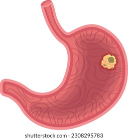 Stomach cancer vector illustration isolated on white background