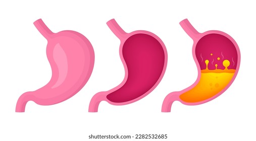 Stomach collection in different state. Healthy and unhealthy, empty and full human stomach. Nutrition, stomach pain, bloating, gastrite. Digestive system anatomy. Vector illustration.