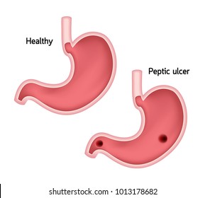 2,702 Peptic ulcers Images, Stock Photos & Vectors | Shutterstock