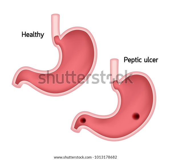 Stomach Comparison Healthy Ulcer Human Stomach Stock Vector (Royalty ...