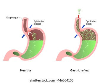 Doença do estômago: eructos, azia ou refluxo. A ilustração estômago, esôfago e esfíncter. Anatomia humana