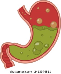 Enfermedad de Stomach. El Estómago Humano está lleno de ácido estómico. Náuseas, Aceite, Reflux Ácido. Ilustración vectorial. Anatomía y medicina