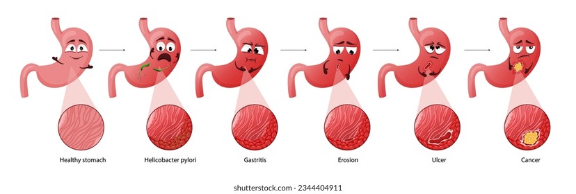 Stomach diseases. Cartoon character with emotions. Diagram diseases helicobacter pylori, gastritis, erosion, ulcer, cancer. Educational anatomical vector illustration isolated white background.