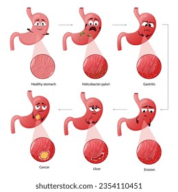 Stomach diseases. Cartoon character with emotions. Diagram diseases helicobacter pylori, gastritis, erosion, ulcer, cancer. Educational anatomical vector illustration isolated white background.