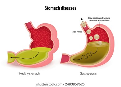 Stomach diseases. Comparison of healthy stomach and gastroparesis. Gastrointestinal Disorders. Vector for use in scientific and medical education.